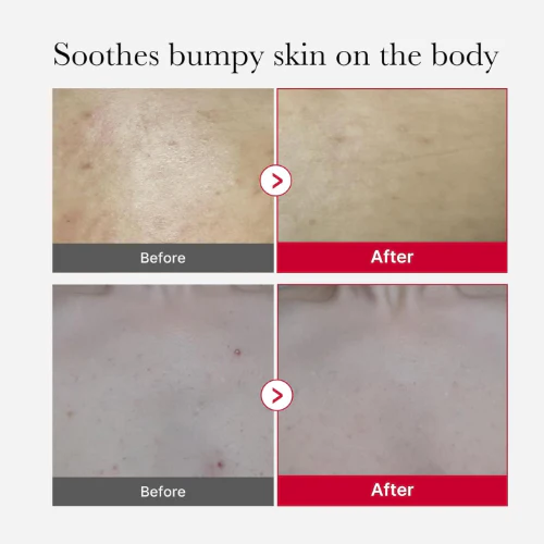 Medicube Exfoliante corporal en spray] Medicube Red Acne Body Peeling Shot